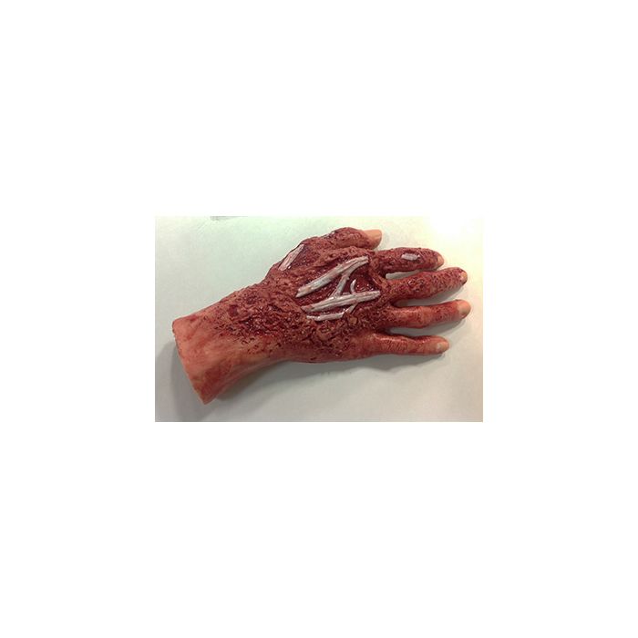 Simulaids Chemical Burn, 4Th Degree, Right Hand
