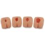 Pressure Ulcer/Bedsore Models, 4-Stages (Set 4)