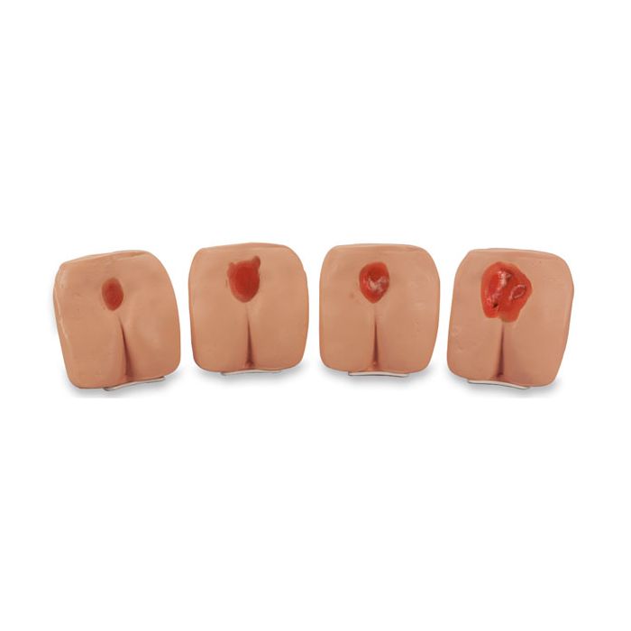 Pressure Ulcer/Bedsore Models, 4-Stages (Set 4)