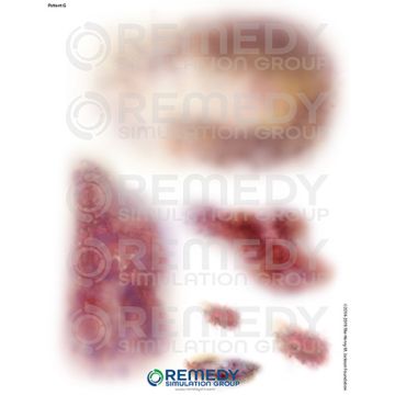  Moulage Tattoos - Patient G Scenario. Qty: 2.