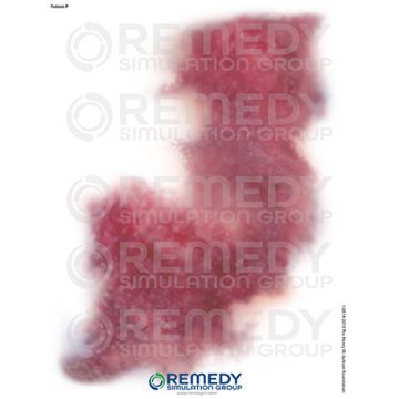 Moulage Tattoos - Patient P Scenario. Qty: 2.