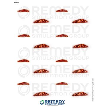 Moulage Tattoos - Patient T Scenario. Qty: 1.